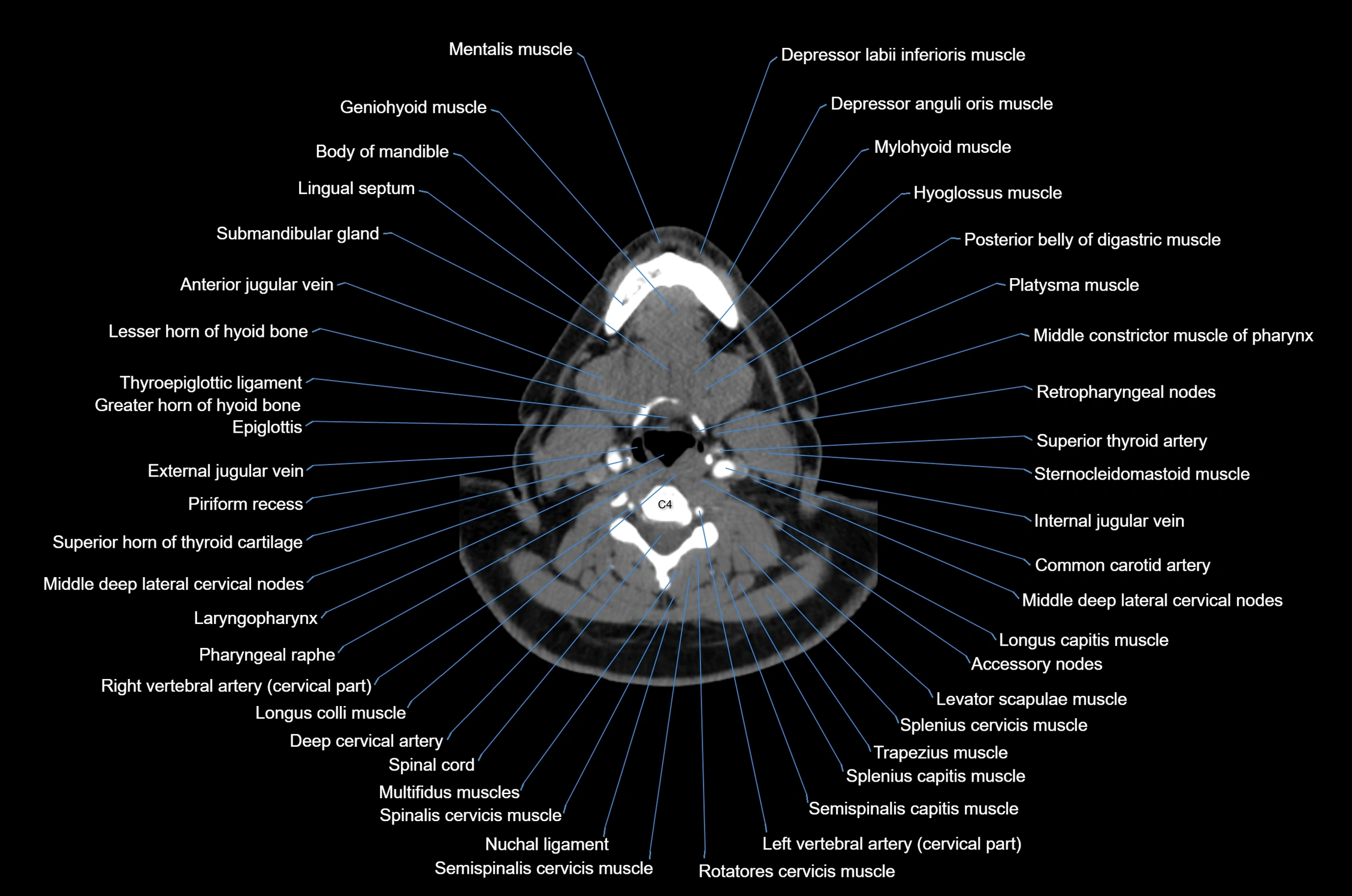CT Neck axial cross sectional anatomy radiology image-img-00001-00038.webp